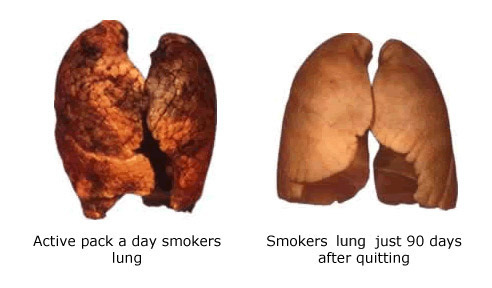 smokers lungs after quitting smoking